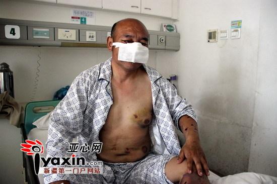 新疆沙灣村民山中撿玉遭棕熊攻擊 鼻子、上嘴唇被咬掉撿回一命（圖）