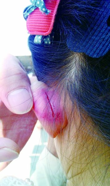 　　女童的耳朵被老師揪裂。圖片由女童家人提供