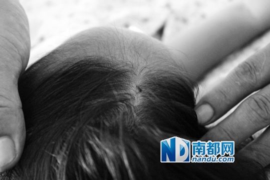 女童頭上被扎的針孔（圓圈處）。賈先生說，被扎不到三秒鐘，女兒就昏了。