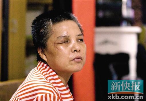 4月初,趙女士遭人搶劫并被打傷,現(xiàn)今右眼失明,頭部被縫100多針。記者 畢志毅/攝