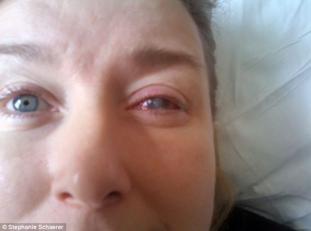 恐怖慎入！隱形眼鏡致英女子摘除眼球