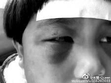 6月2日，網(wǎng)曝渭南市臨渭區(qū)一不滿5歲的女童遭奶奶毆打，眼圈青腫，引起網(wǎng)友關(guān)注，但孩子父母和爺爺均稱是摔倒導(dǎo)致。相關(guān)部門介入調(diào)查發(fā)現(xiàn)確為奶奶毆打所致，鑒于其身體原因已進(jìn)行批評(píng)教育。
