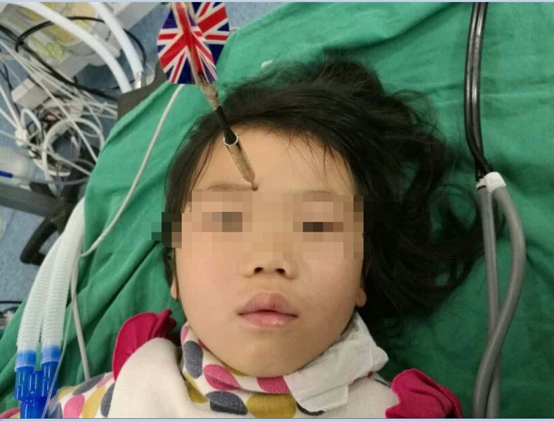 十多公分長的飛鏢穩(wěn)穩(wěn)地 ” 定 ” 在了一名六歲半的女童額頭上，小青一家人凌晨從長順趕到貴醫(yī)附院急診室時，看到如此慘烈的情況，接診醫(yī)生都嚇了一跳。詳細(xì)詢問下得知，原來是七歲的哥哥和六歲半的表妹在玩耍時，哥哥不慎將路邊撿來的真飛鏢扎到了妹妹的額頭上。