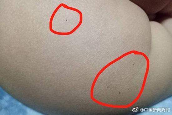 據(jù)多名紅黃藍(新天地分園)家長反映，孩子腿部、屁股、腋下出現(xiàn)針眼。