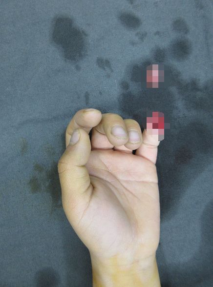 嚇哭！6歲男孩被夾斷手指 罪魁禍?zhǔn)拙故切７? oldsrc=