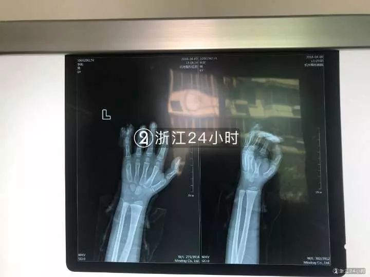 嚇哭！6歲男孩被夾斷手指 罪魁禍?zhǔn)拙故切７? oldsrc=