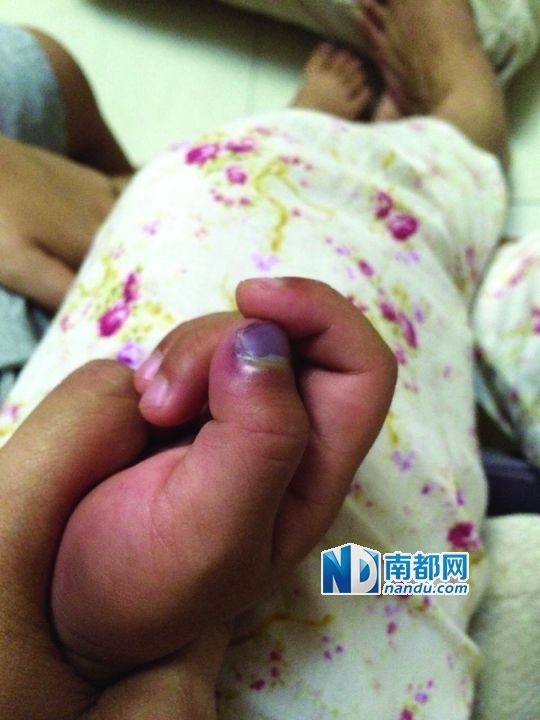 小逸手指被夾傷。
