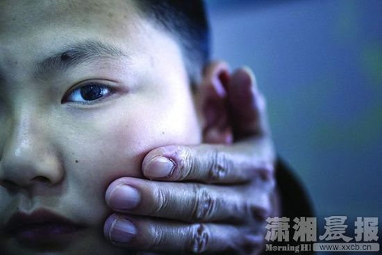 1月13日，小玨的父親心疼地摸著兒子的臉。
