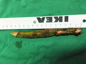 插入男子腦內(nèi)的樹枝。