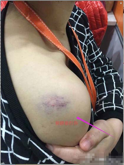 曾女士稱肩頭的傷情是滴滴司機(jī)追打所致