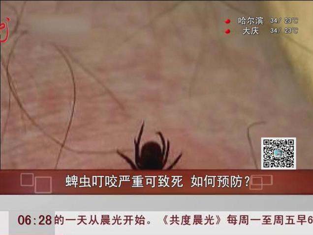 蜱蟲叮咬嚴(yán)重可致死如何預(yù)防？